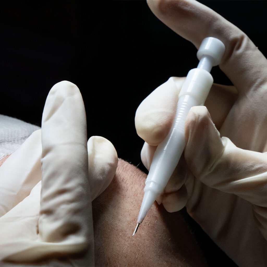 What_is_DHI_Hair_Transplant_1200x1200